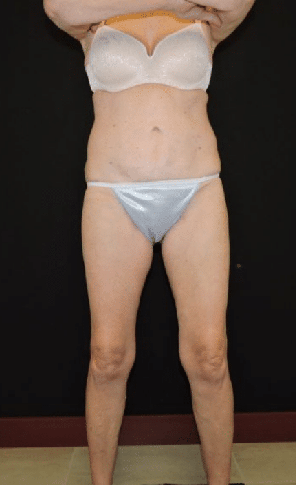 CoolSculpting Fat Reduction Before and After Slider: After Image
