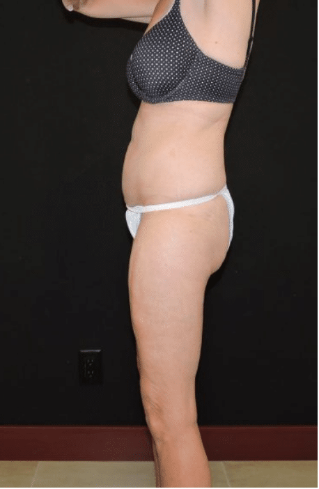 CoolSculpting Chin Reduction Before and After Slider 3: After Image