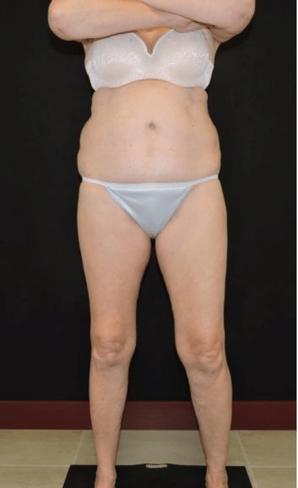 CoolSculpting Fat Reduction Before and After Slider: Before Image