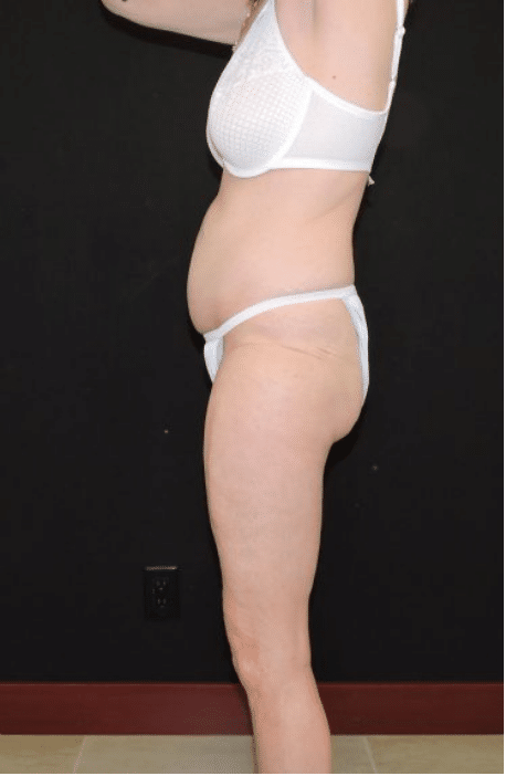 CoolSculpting Chin Reduction Before and After Slider 3: Before Image