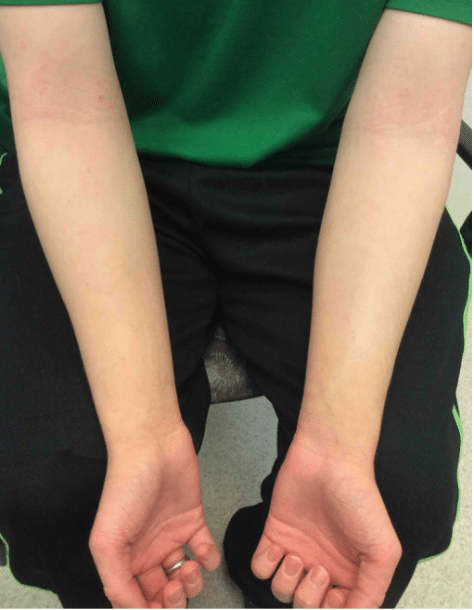 After: Acne Before and After Slider: After Image