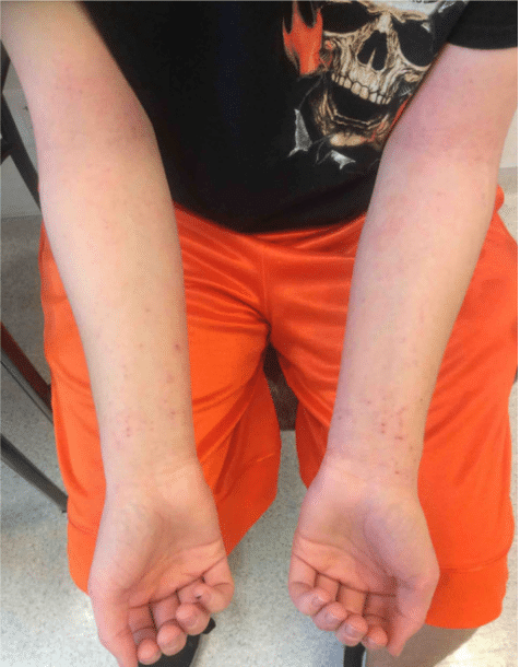 Eczema Before and After Slider: After Image