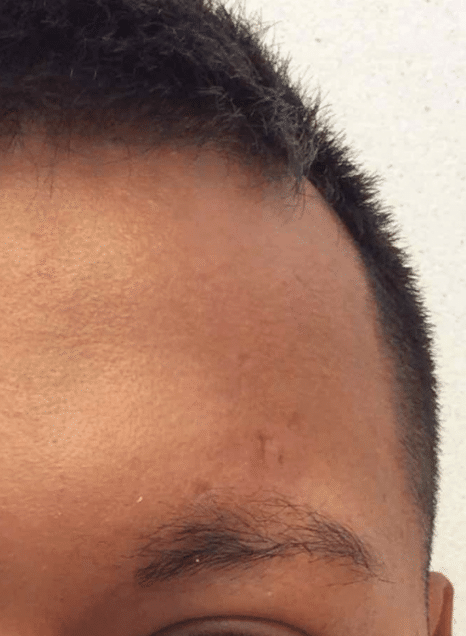 IPL Before and After Slider 2: After Image