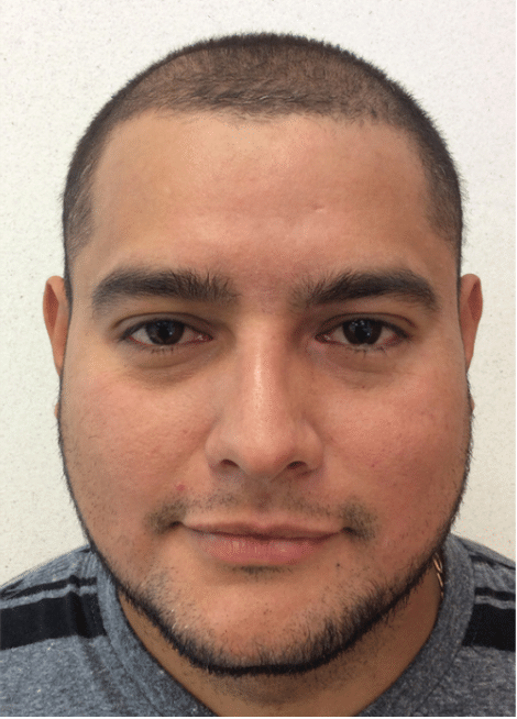 After: Acne Before and After Slider 2: After Image
