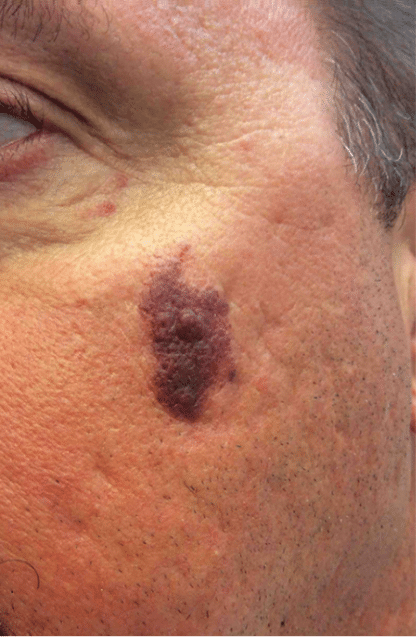 IPL Before and After Slider: Before Image