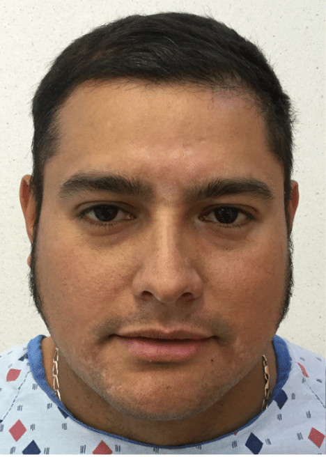 Before: Acne Before and After Slider 2: Before Image