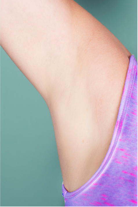 Laser Hair Removal Before and After Slider: After Image