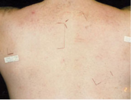 Laser Hair Removal Before and After Slider 1: After Image