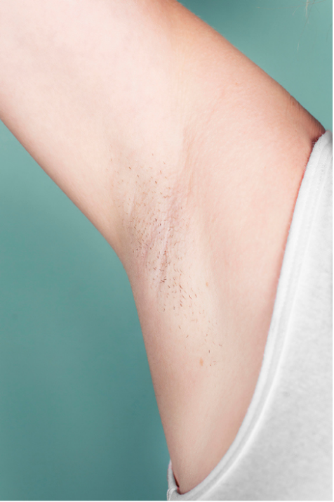 Laser Hair Removal Before and After Slider: Before Image