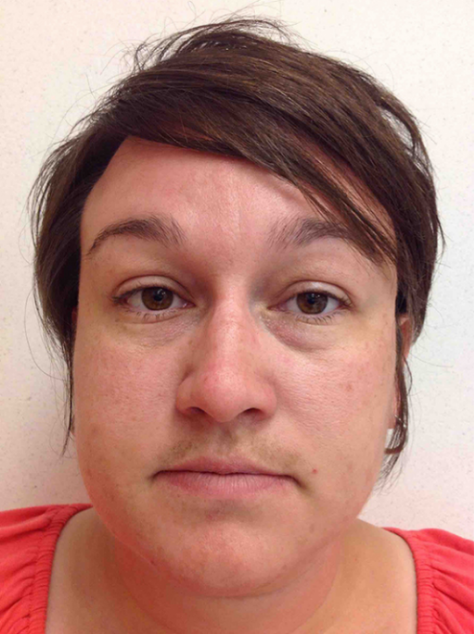 Laser Hair Removal Before and After Slider 3: Before Image