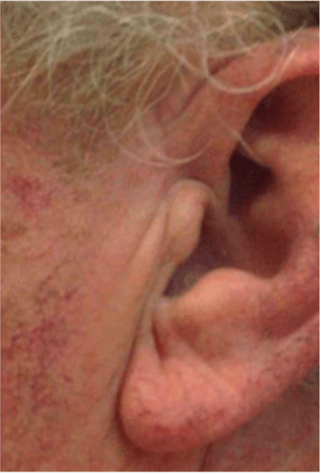 MOH's Skin Cancer Removal Before and After Slider 1: After Removal Image
