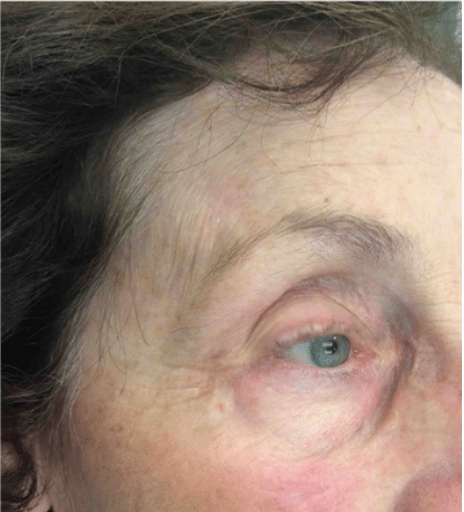 Mohs Skin Cancer Removal Before and After Slider 2: After Removal Image