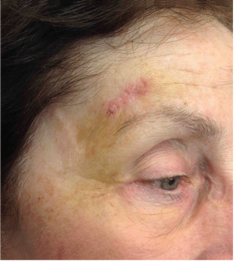 Mohs Skin Cancer Removal Before and After Slider 2: Before Removal Image
