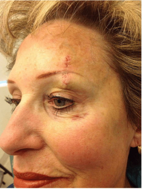 Mohs Skin Cancer Removal Before and After Slider 3: Before Removal Image