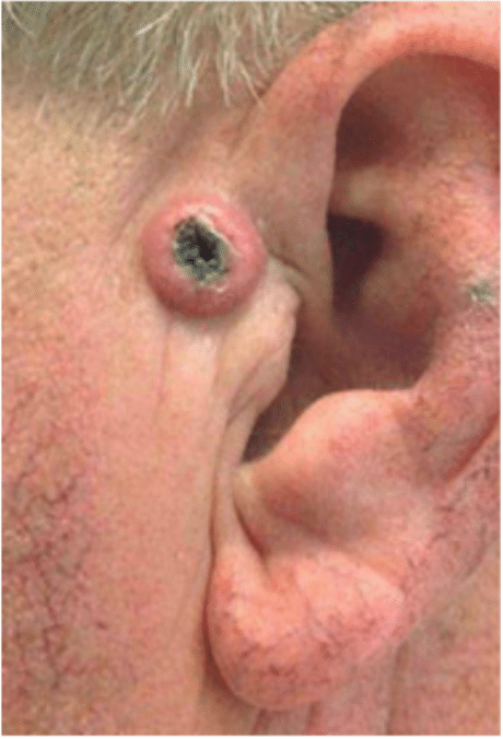 Mohs Skin Cancer Removal Before and After Slider: Before Removal Image