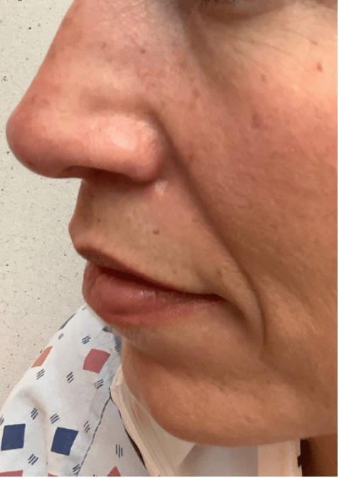 Mole Before and After Slider: After Removal Image