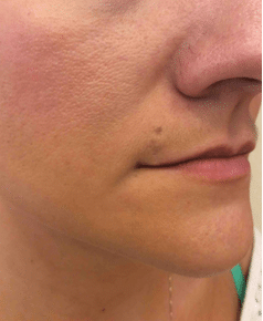 Mole Removal Before and After Slider 3: After Mole Removal Image