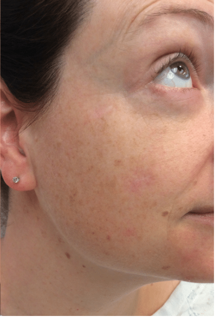 Mole Removal Before and After Slider 2: After Image