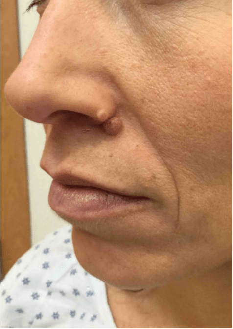 Mole Before and After Slider: Before Removal Image