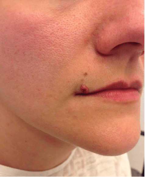 Mole Removal Before and After Slider 3: Before Removal Image