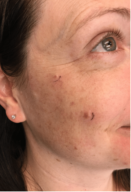 Eczema Before and After Slider 2: Before Removal Image