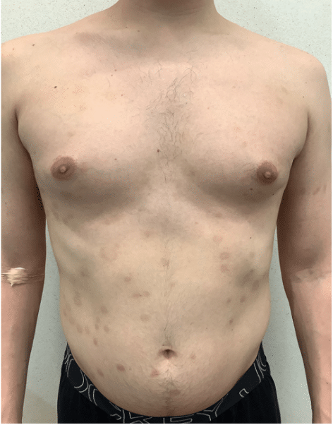 Psoriasis Before and After Slider: After Image