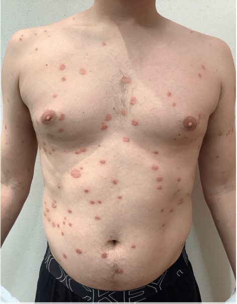 Psoriasis Before and After Slider: Before Image