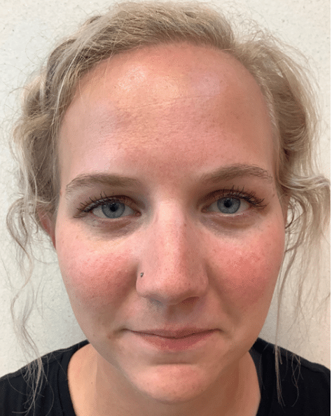 Rosacea Before and After Slider 2: After Image