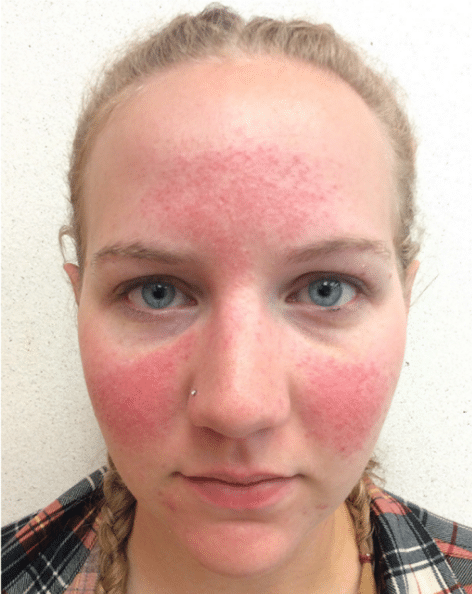 Rosacea Before and After Slider: Before Image
