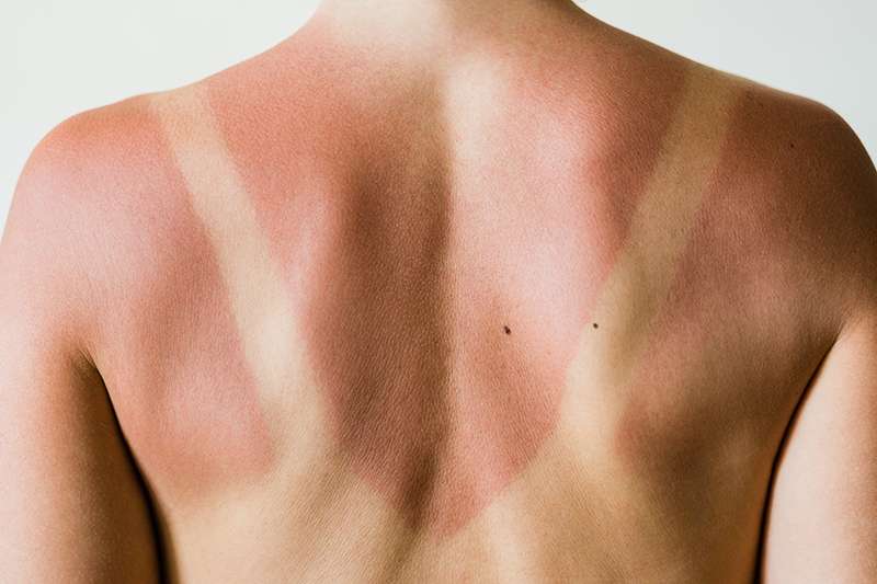 Person with Sunburn on back and shoulders with tan lines