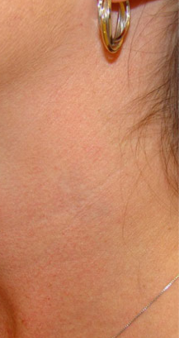 Tattoo Removal Before and After Slider: After Image