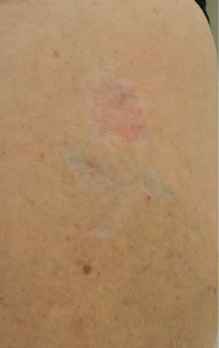 Tattoo Removal Before and After Slider 1: After Image