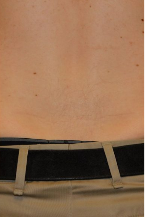 Tattoo Removal Before and After Slider 3: After Image