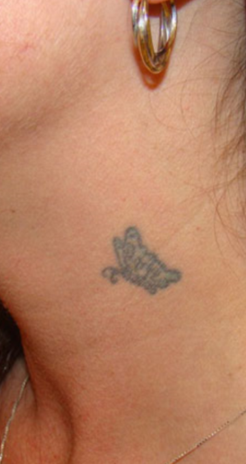 Tattoo Removal Before and After Slider: Before Image
