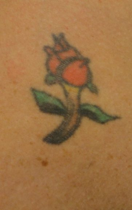 Tattoo Removal Before and After Slider 1: Before Image