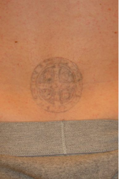 Tattoo Removal Before and After Slider 3: Before Image