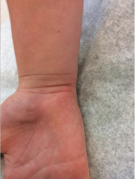 Wart Removal Before and After Slider 1: After Image