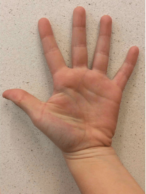 Wart Removal Before and After Slider: After Image