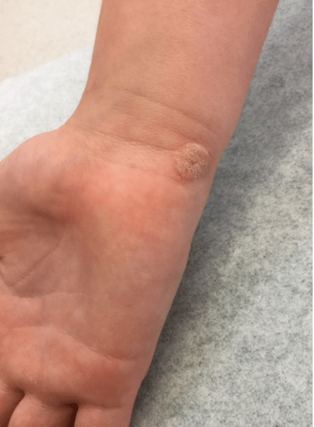 Wart Removal Before and After Slider 1: Before Image
