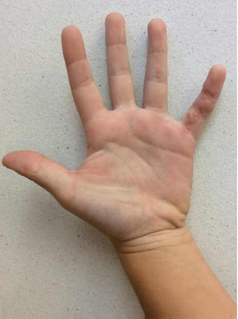 Wart Removal Before and After Slider: Before Image