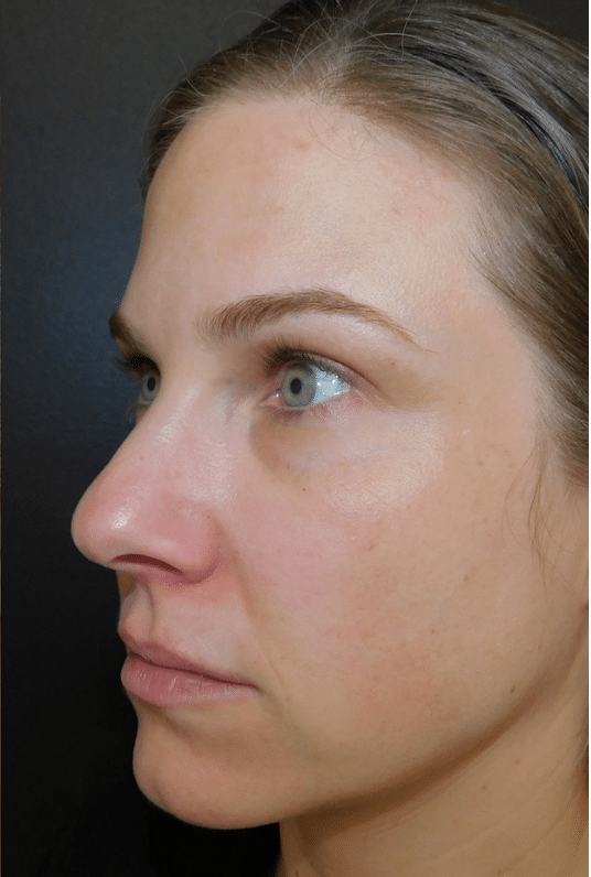 Laser Resurfacing Before and After Slider 1: After Image