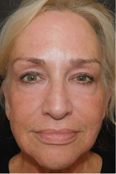 Laser Resurfacing Before and After Slider: After Image