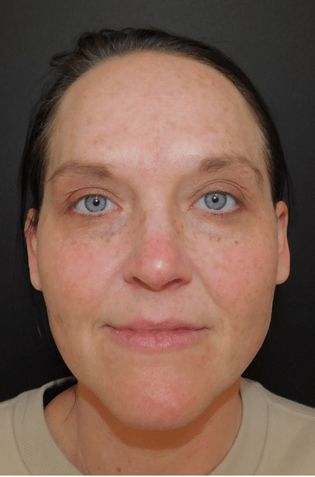 Laser Resurfacing Before and After Slider 3: After Image