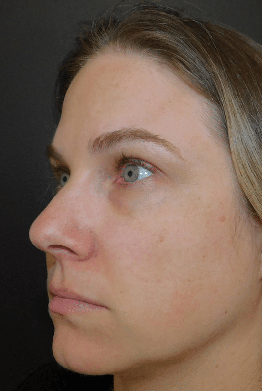 Laser Resurfacing Before and After Slider 1: Before Image