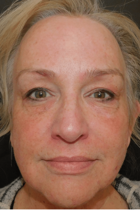 Laser Resurfacing Before and After Slider: Before Image