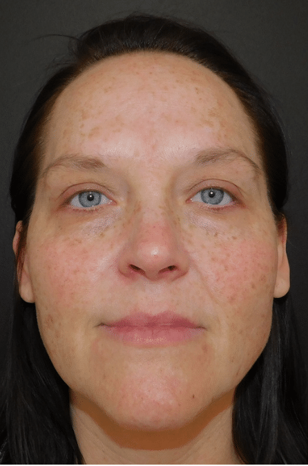 Laser Resurfacing Before and After Slider 3: Before Image